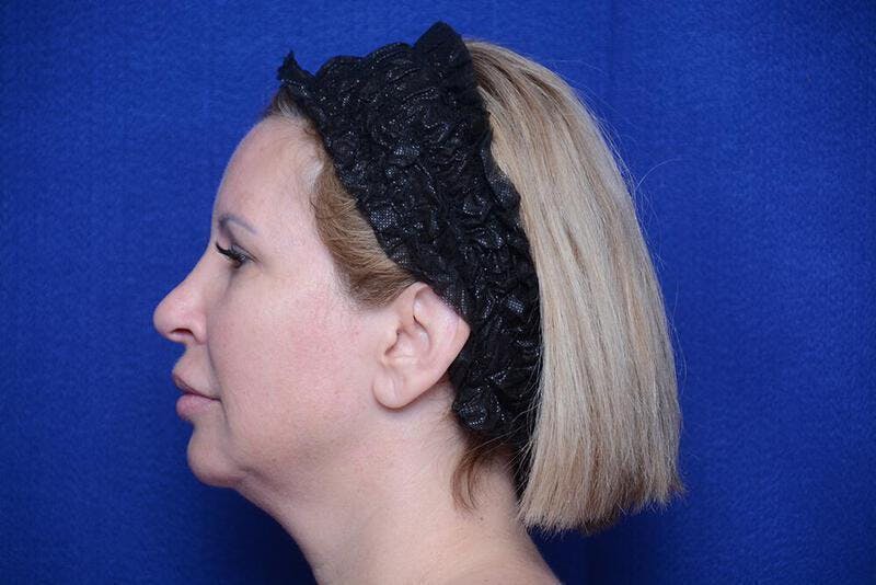 Chin Implant Before & After Gallery - Patient 198217 - Image 1