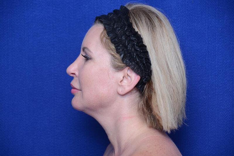 Chin Implant Before & After Gallery - Patient 198217 - Image 2