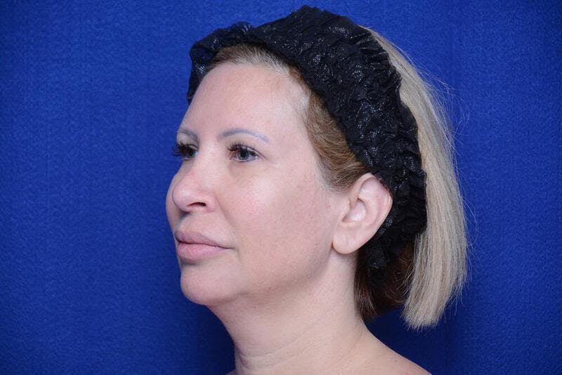 Chin Implant Before & After Gallery - Patient 198217 - Image 3
