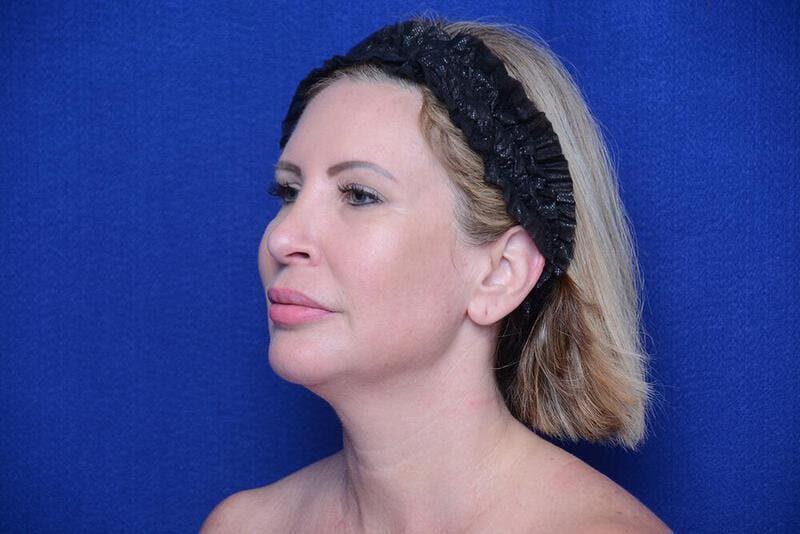 Chin Implant Before & After Gallery - Patient 198217 - Image 4