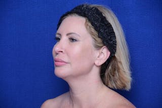 Chin Implant Before & After Gallery - Patient 198217 - Image 4