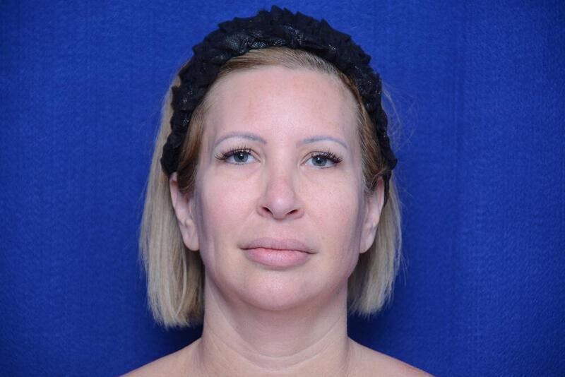 Chin Implant Before & After Gallery - Patient 198217 - Image 5