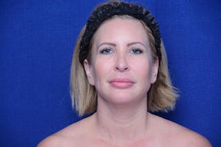 Chin Implant Before & After Gallery - Patient 198217 - Image 6