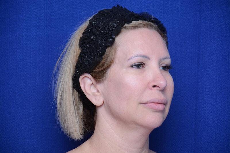 Chin Implant Before & After Gallery - Patient 198217 - Image 7