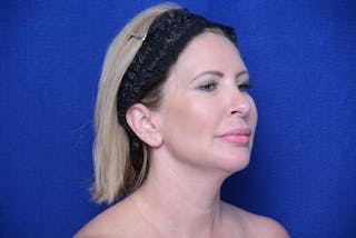 Chin Implant Before & After Gallery - Patient 198217 - Image 8