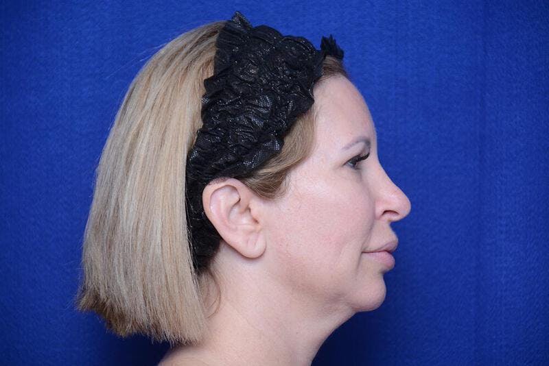 Chin Implant Before & After Gallery - Patient 198217 - Image 9