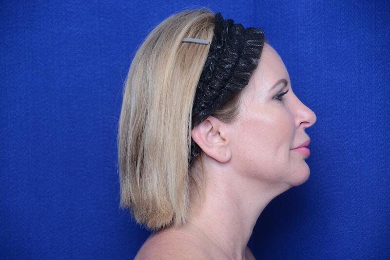 Chin Implant Before & After Gallery - Patient 198217 - Image 10