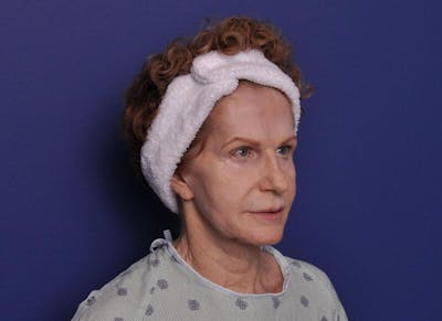Facelift Before & After Gallery - Patient 200699 - Image 1