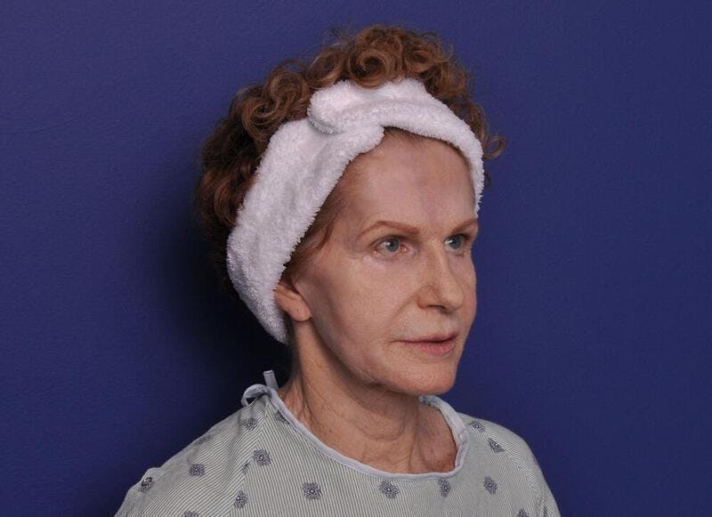 Facelift Before & After Gallery - Patient 200699 - Image 1