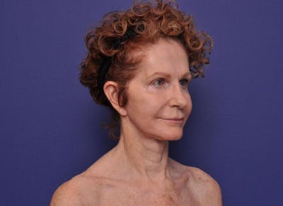 Facelift Before & After Gallery - Patient 200699 - Image 2