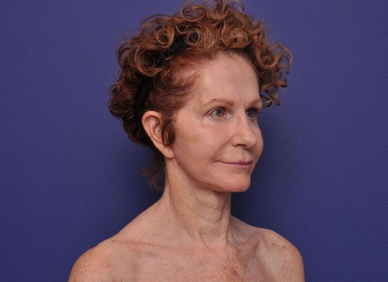Facelift Before & After Gallery - Patient 200699 - Image 2