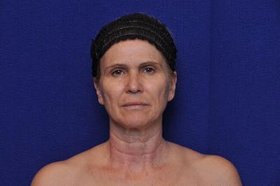 Facelift Before & After Gallery - Patient 977838 - Image 1