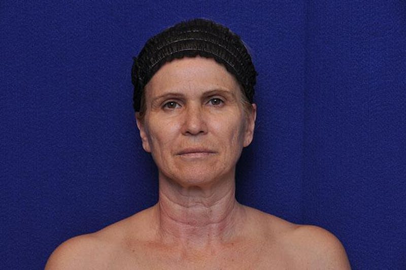Facelift Before & After Gallery - Patient 977838 - Image 1