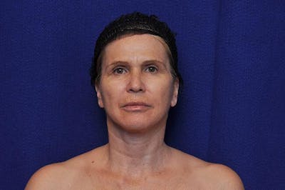 Facelift Before & After Gallery - Patient 977838 - Image 2