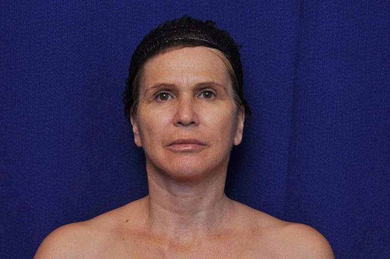 Facelift Before & After Gallery - Patient 977838 - Image 2