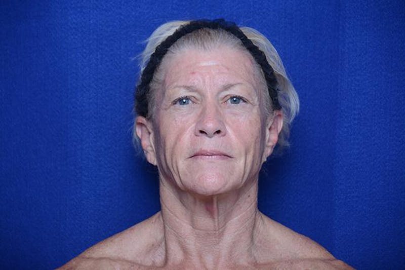 Facelift Before & After Gallery - Patient 288073 - Image 1