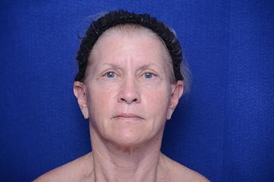 Facelift Before & After Gallery - Patient 288073 - Image 2