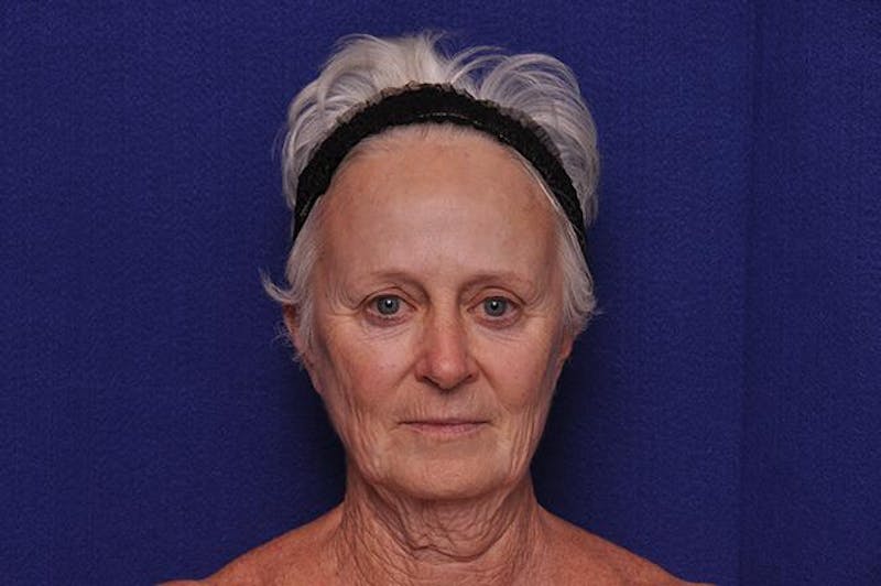 Facelift Before & After Gallery - Patient 128173 - Image 1