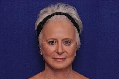 Facelift Before & After Gallery - Patient 128173 - Image 2