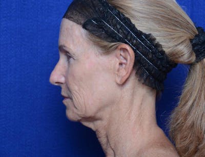 Facelift Before & After Gallery - Patient 281623 - Image 1