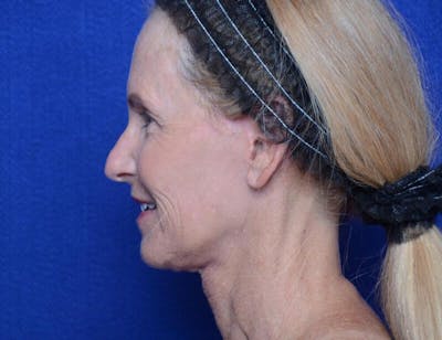 Facelift Before & After Gallery - Patient 281623 - Image 2