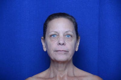 Facelift Before & After Gallery - Patient 552807 - Image 1