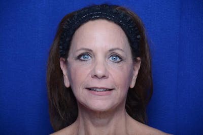 Facelift Before & After Gallery - Patient 552807 - Image 2
