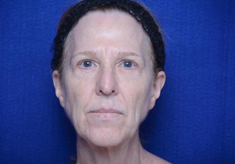 Facelift Before & After Gallery - Patient 267129 - Image 1
