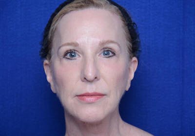 Facelift Before & After Gallery - Patient 267129 - Image 2