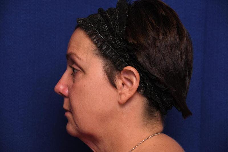 Facelift Before & After Gallery - Patient 162233 - Image 1