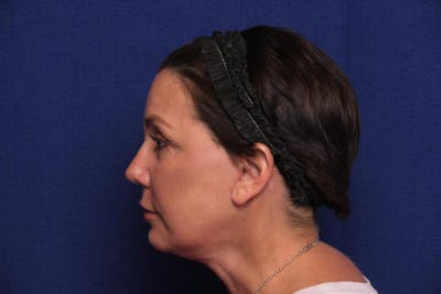 Facelift Before & After Gallery - Patient 162233 - Image 2
