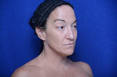 Fat Transfer to Lips Before & After Gallery - Patient 131922 - Image 1