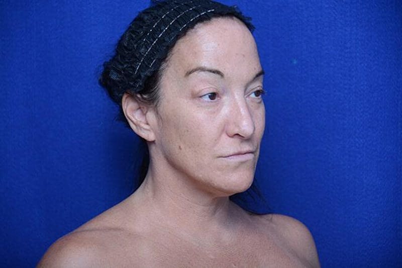 Fat Transfer to Lips Before & After Gallery - Patient 131922 - Image 1