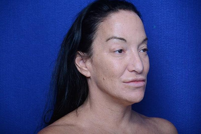 Fat Transfer to Lips Before & After Gallery - Patient 131922 - Image 2