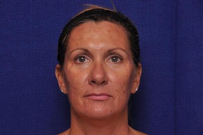 Fractional Laser Before & After Gallery - Patient 341556 - Image 1