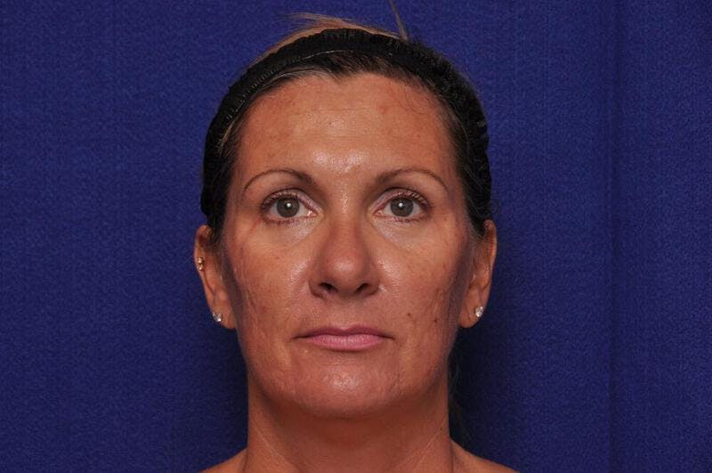 Fractional Laser Before & After Gallery - Patient 341556 - Image 1