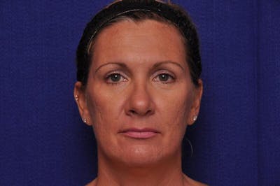 Fractional Laser Before & After Gallery - Patient 341556 - Image 2