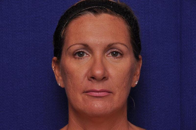Fractional Laser Before & After Gallery - Patient 341556 - Image 2
