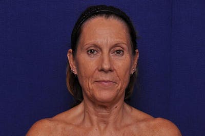 Fractional Laser Before & After Gallery - Patient 186937 - Image 1