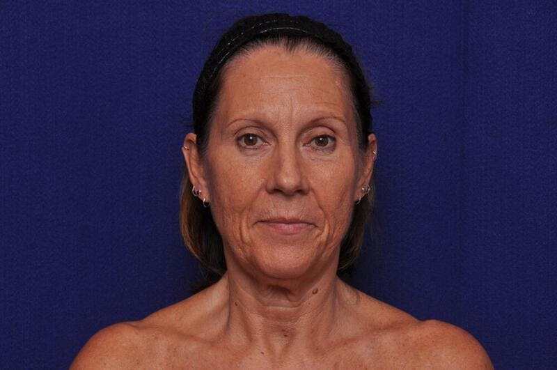 Fractional Laser Before & After Gallery - Patient 186937 - Image 1