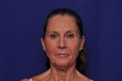Fractional Laser Before & After Gallery - Patient 186937 - Image 2