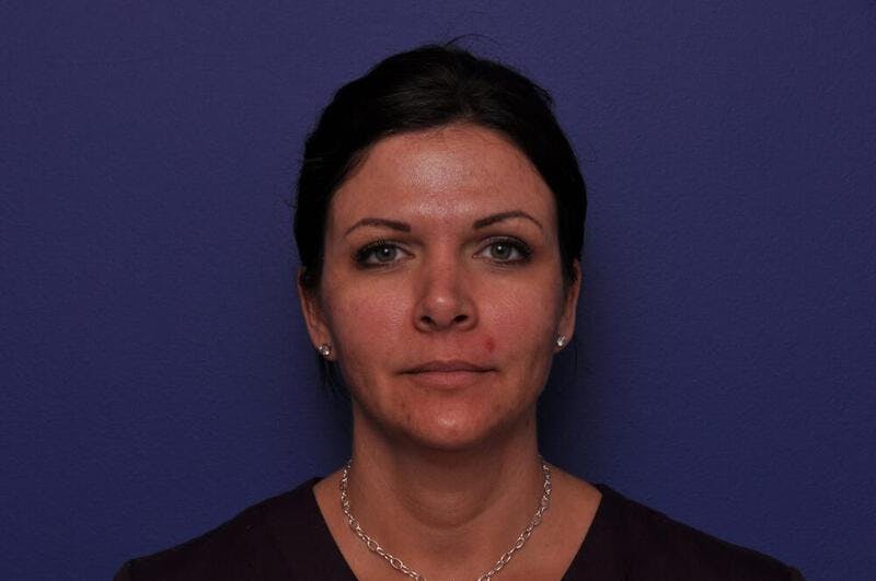 Fractional Laser Before & After Gallery - Patient 274971 - Image 1