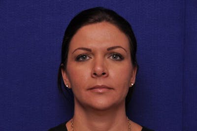Fractional Laser Before & After Gallery - Patient 274971 - Image 2