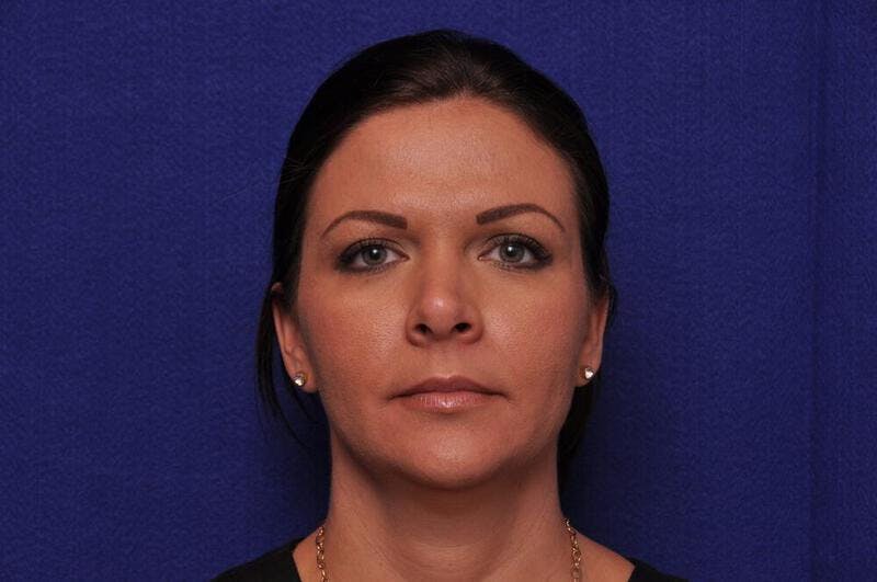 Fractional Laser Before & After Gallery - Patient 274971 - Image 2