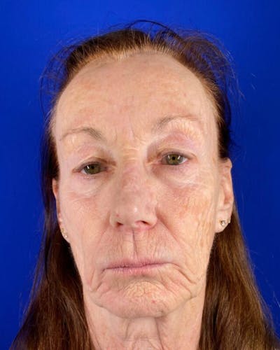 Injectable Cheek Lift Before & After Gallery - Patient 397109 - Image 1