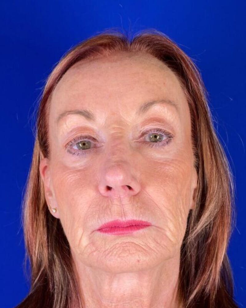 Injectable Cheek Lift Before & After Gallery - Patient 397109 - Image 2