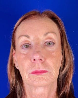Injectable Cheek Lift Before & After Gallery - Patient 397109 - Image 2