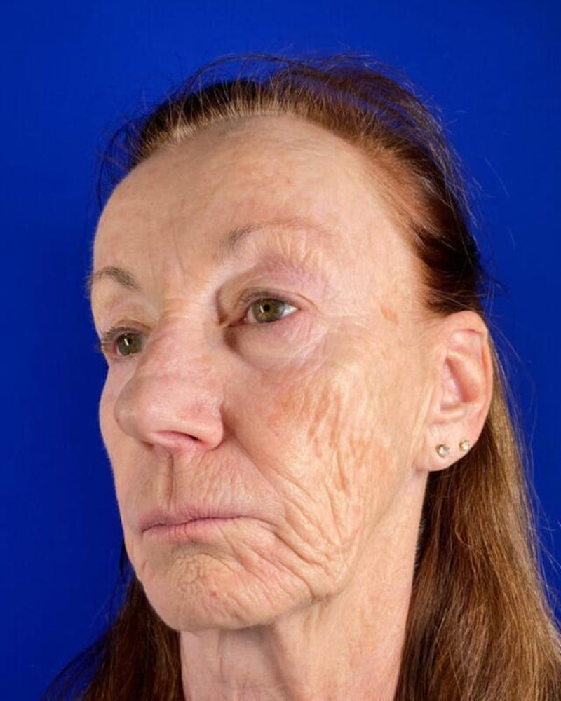 Injectable Cheek Lift Before & After Gallery - Patient 397109 - Image 3