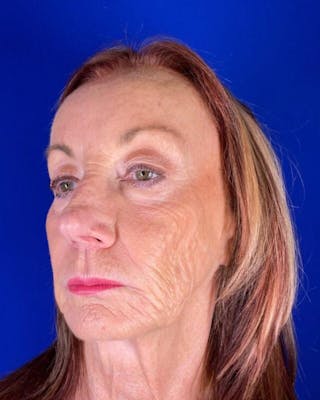 Injectable Cheek Lift Before & After Gallery - Patient 397109 - Image 4