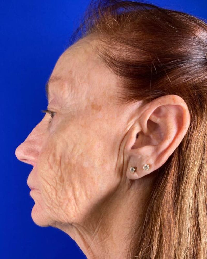 Injectable Cheek Lift Before & After Gallery - Patient 397109 - Image 5